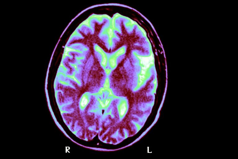Исследование показало, что почти у всех людей с двумя копиями этого генетического варианта развиваются признаки болезни Альцгеймера