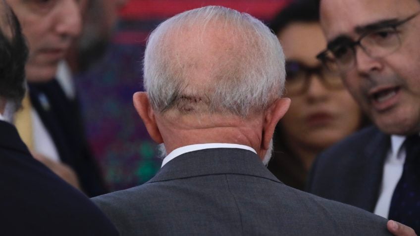 Corte na cabeça do presidente Lula após queda em banheiro