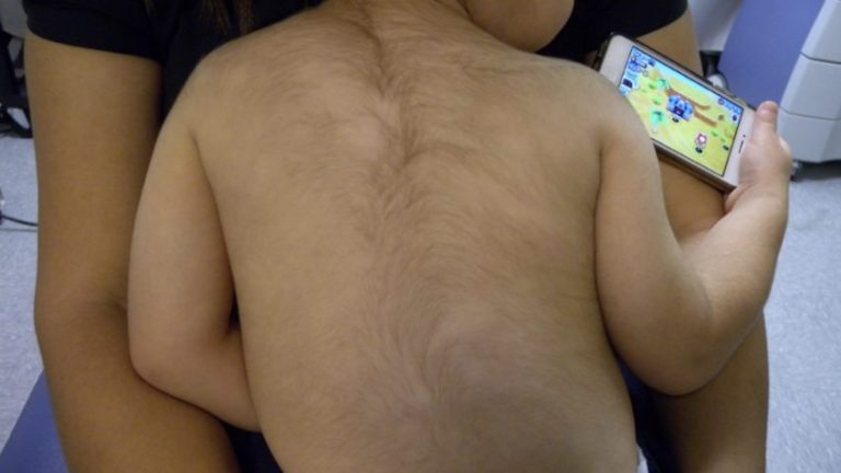 Criança minoxidil